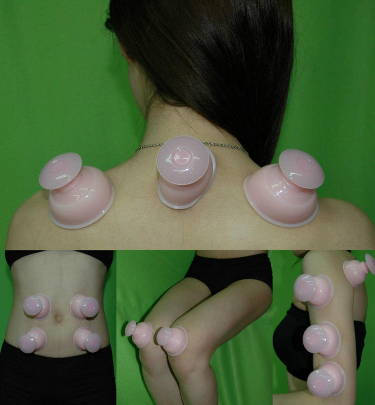 What is a silicone cupping set?