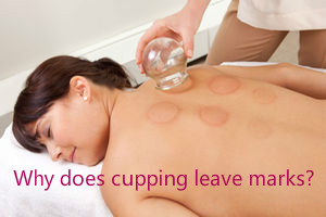 lierre-blog-why-does-cupping-leave-marks