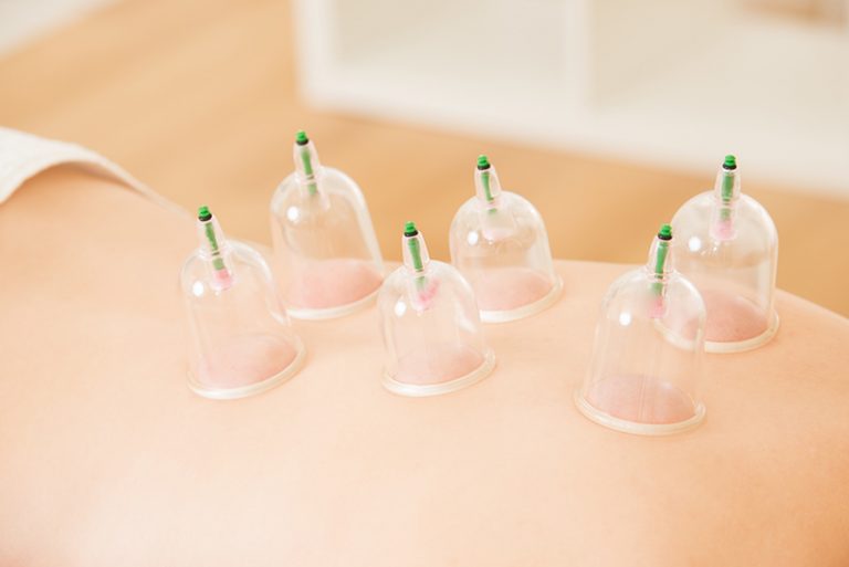 Different Methods of Cupping Therapy