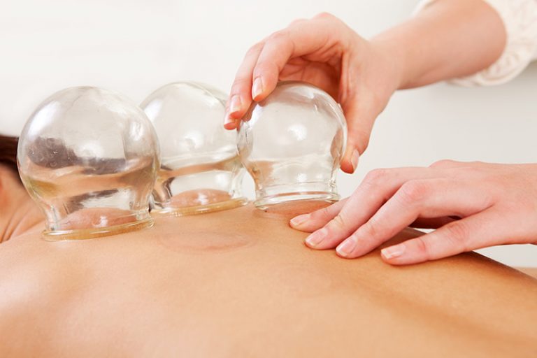 Is there Scientific Support for Cupping