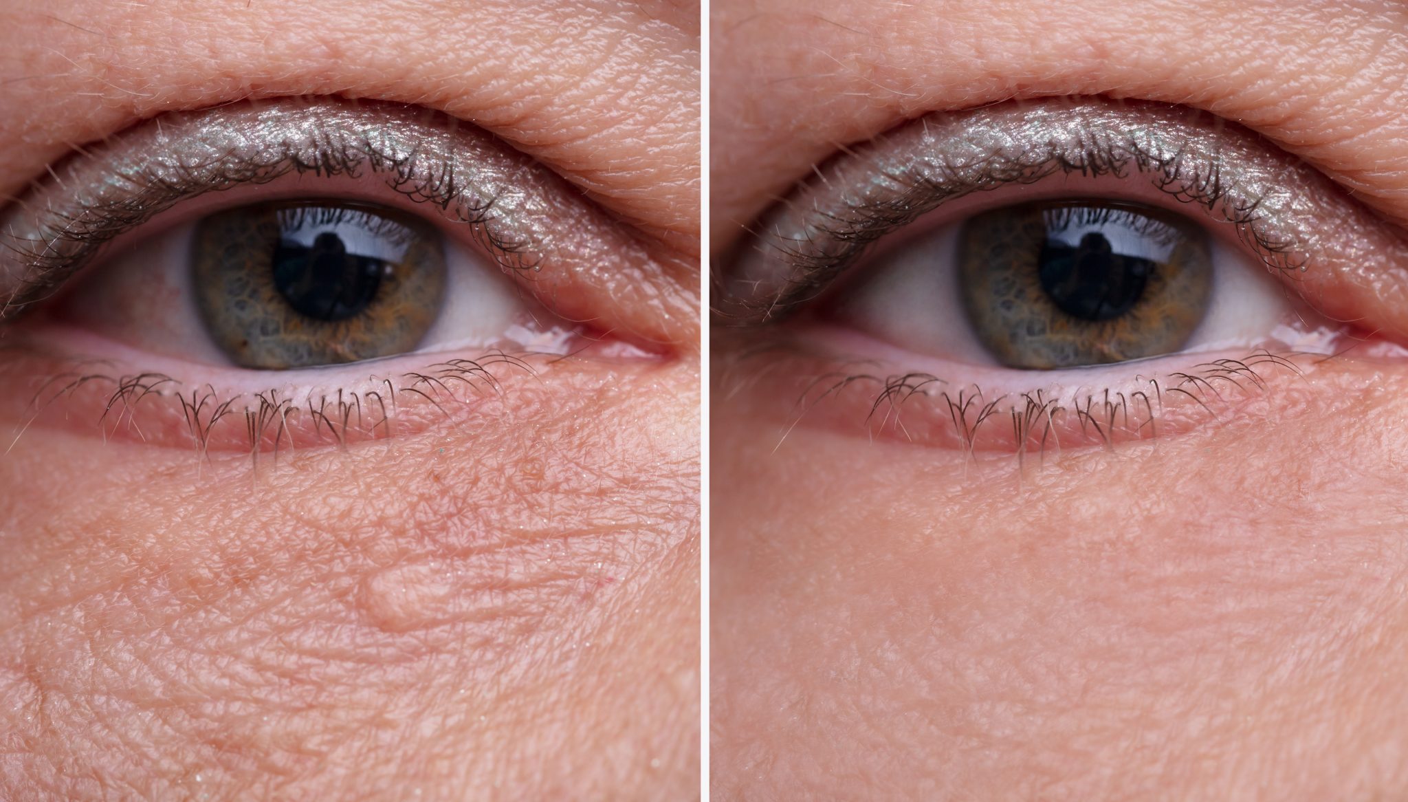 9 Causes of Dark Eye Circles  Take action to reduce dark circles under eyes  with natural noninvasive methods  Blissoma Botanical Beauty