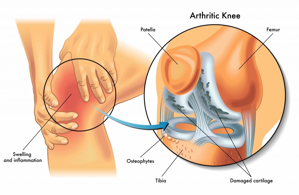 What are the early signs of arthritis?