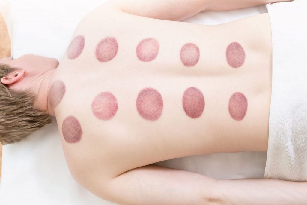 What does cupping marks mean?