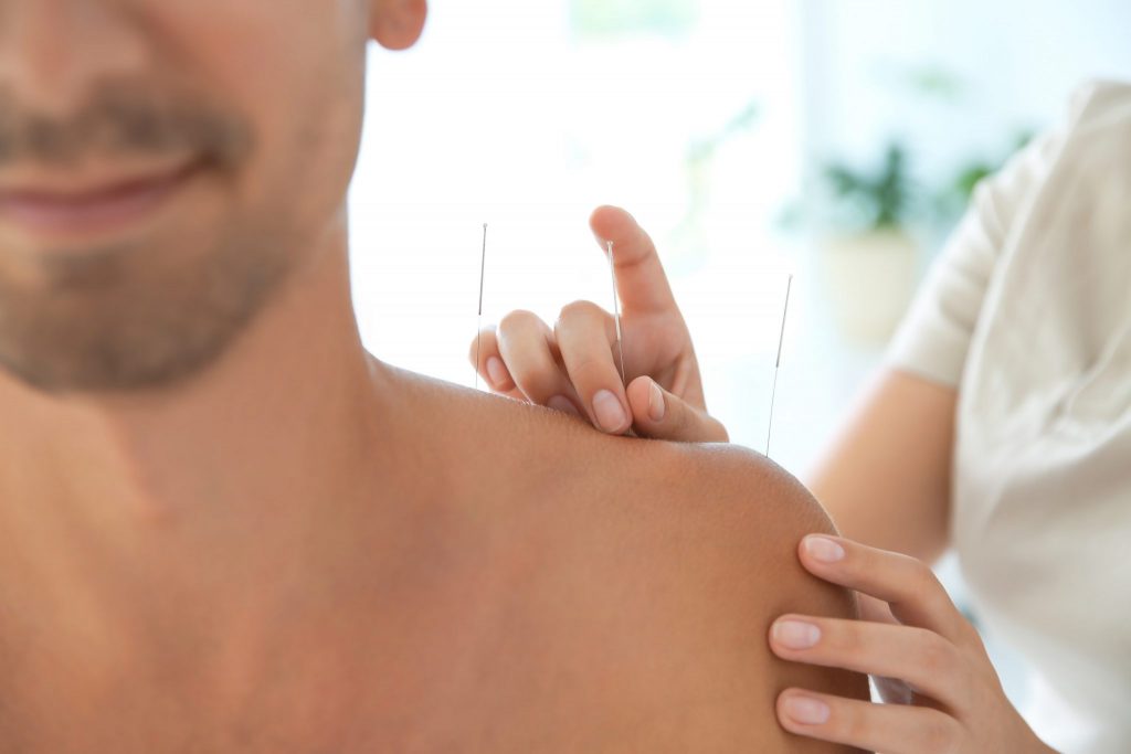 What is the difference between acupuncture and dry needling?