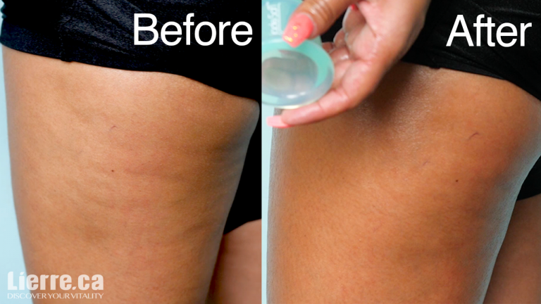 How to Get Rid of Cellulite