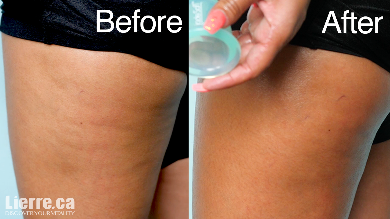 How to Get Rid of Cellulite  Featuring Jade Soft™ Slicone Cupping
