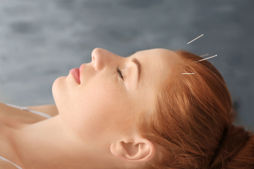 Acupuncture for headaches from Lierre.ca Canada