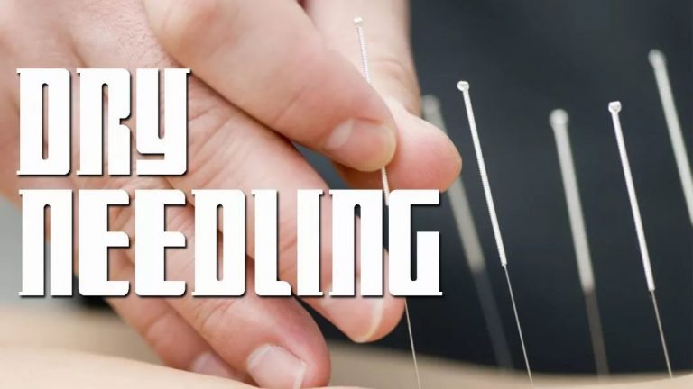 What Does Dry Needling Mean and How Does it Differ From Acupuncture