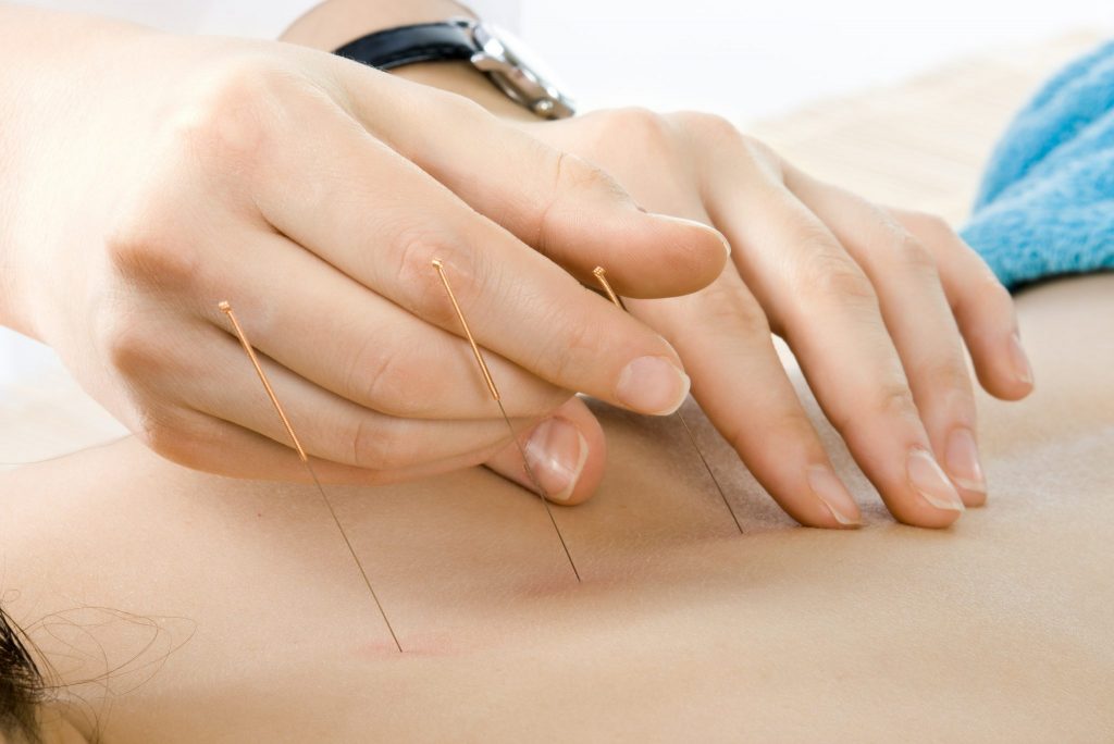 Acupuncture needles from Lierre.ca Canada - Black Friday Deals from Lierre.ca 