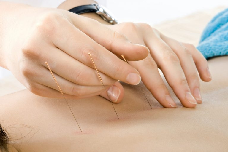 L’acupuncture – Black Friday avec Lierre.ca