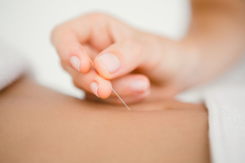 Acupuncture needles on sale for Black Friday from Lierre.ca Canada