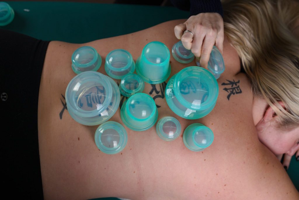 Cupping for Neck Pain Relief from Lierre.ca Canada