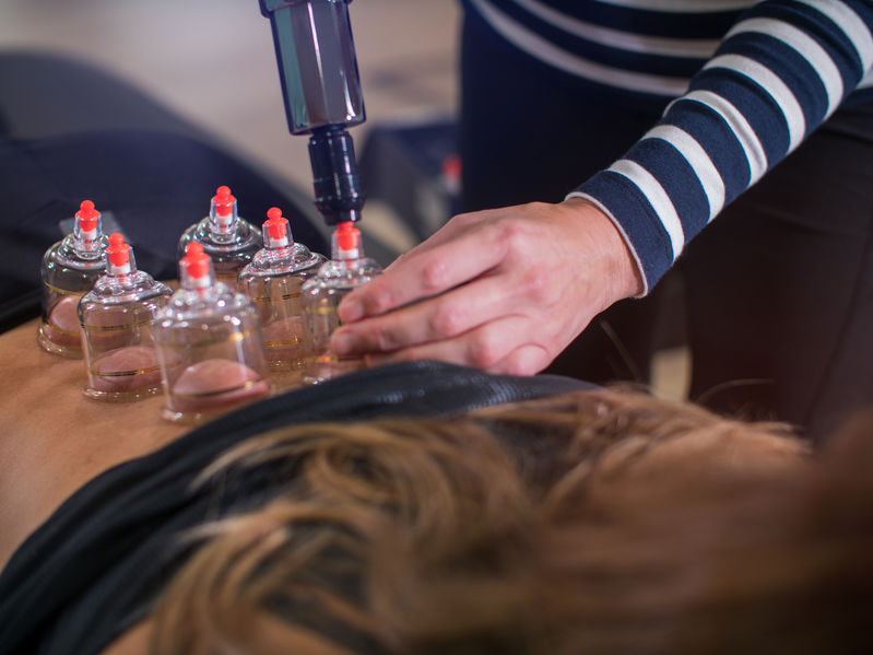 What are the benefits of cupping?